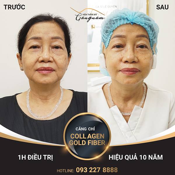 Cô Minh Ánh cải thiện và xóa nếp nhăn ở mắt tới 80% ngay sau 1 giờ thực hiện căng chỉ Collagen Gold Fiber