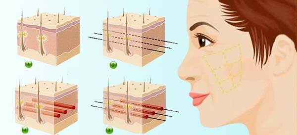 Công nghệ căng da mặt bằng chỉ vàng 24K với “ma trận” liên kết chỉ vàng dưới da, giúp kéo cao cơ chùng chảy, lấp đầy các rãnh nhăn nhờ cơ chế kích thích tăng sinh collagen