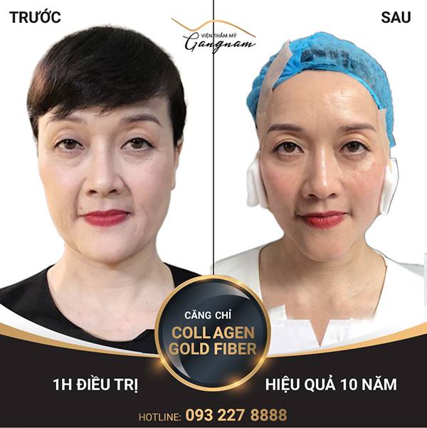 Khách hàng cải thiện nếp nhăn giữa 2 lông mày và trẻ hóa toàn mặt sau căng chỉ Collagen Gold Fiber.