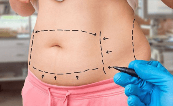 Phẫu thuật bóc mỡ bụng được thực hiện nhanh chóng nhưng dễ để lại sẹo lớn