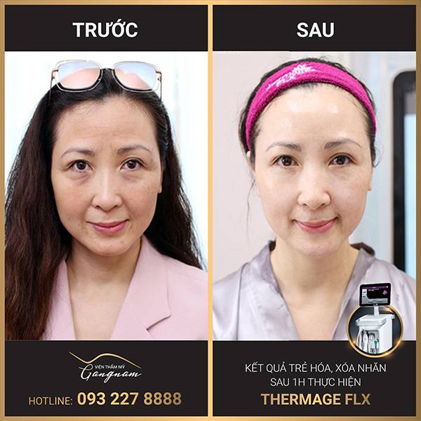 Diễn viên Khánh Huyền trước & sau khi thực hiện xóa nhăn với công nghệ trẻ hóa da Thermage FLX 