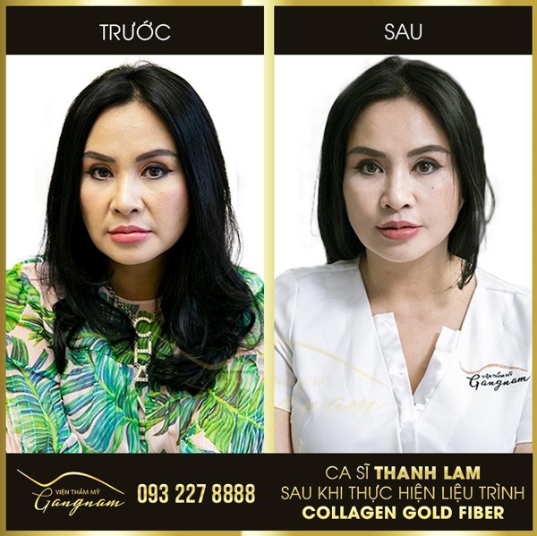 Diva Thanh Lam là một trong những khách hàng đầu tiên được trải nghiệm trẻ hóa xóa nhăn - căng chỉ Collagen Gold Fiber