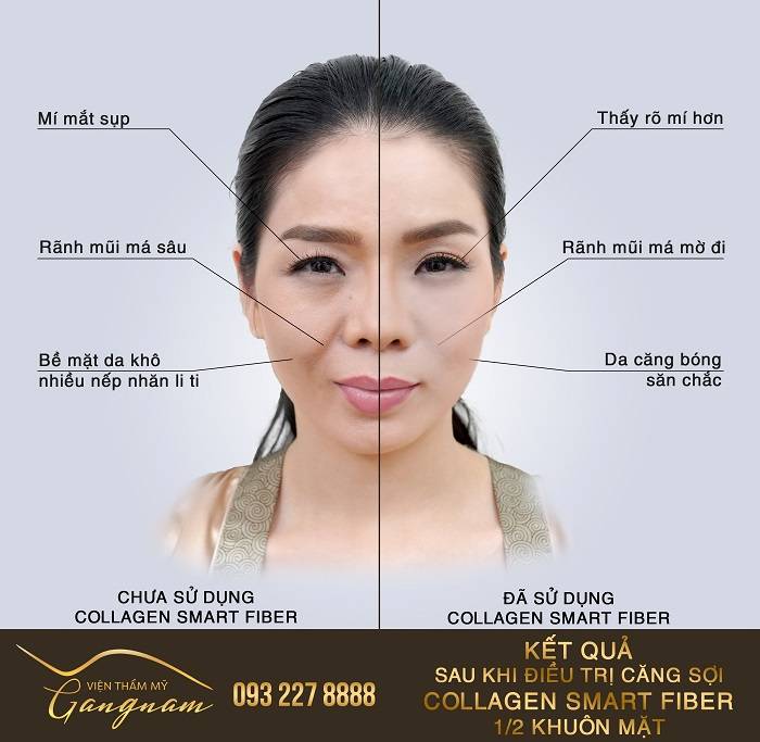 So sánh sự khác biệt: Kết quả sau khi điều trị căng sợi Collagen 1/2 khuôn mặt
