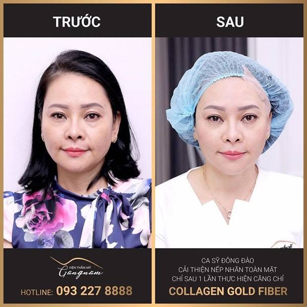 Hình ảnh trước và sau của ca sĩ Đông Đào khi thực hiện căng chỉ collagen - vàng mang tên Collagen Gold Fiber