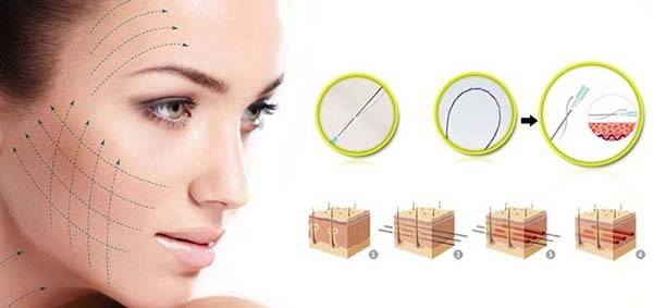 Căng da mặt bằng chỉ sinh học collagen là một trong những phương pháp làm đẹp được ưa chuộng