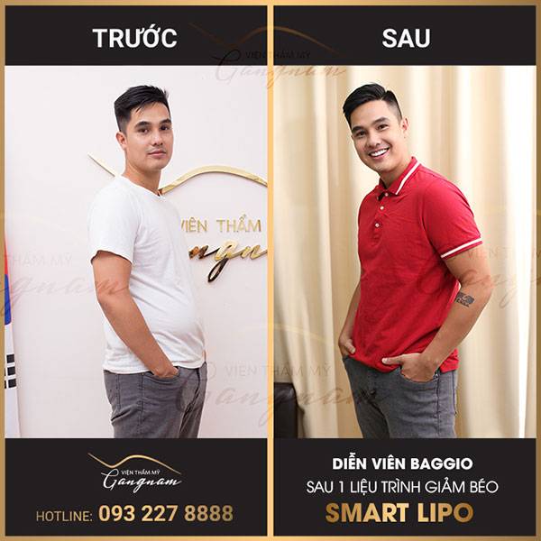  Hình ảnh trước và sau khi thực hiện liệu trình giảm béo bụng nam giới - Smart Lipo