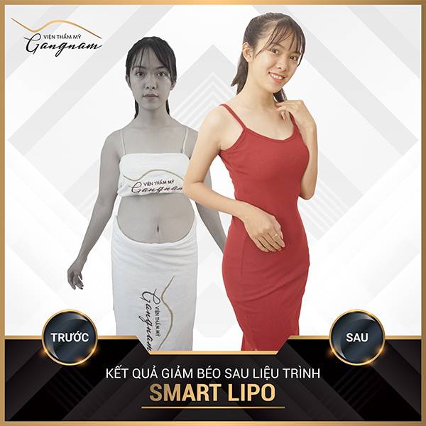 1 lần cấy Smart Lipo giảm béo mỡ bụng chị khách đã tự tin diện đầm body cuốn hút