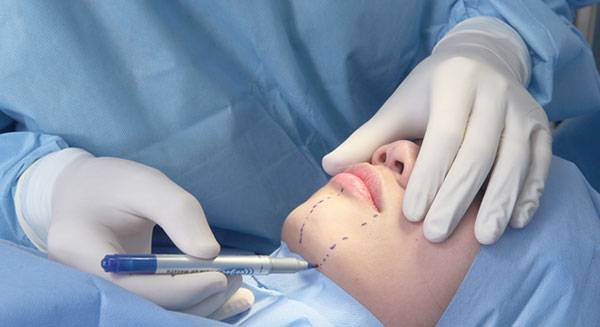 Phẫu thuật hút mỡ là một trong những phương pháp nhanh chóng giảm mỡ trên mặt.