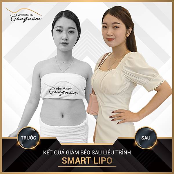 Smart Lipo giúp chị gái giảm 20cm vòng 2 chỉ sau 1 lần thực hiện