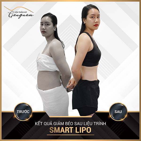 Chị khách sở hữu vòng hai thon gọn khi kết hợp đi bộ giảm mỡ bụng và cấy tinh chất giảm béo Smart Lipo