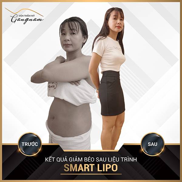Chị gái giảm mỡ bụng sau sinh khi đang cho con bú với công nghệ Smart Lipo tại Mega Gangnam