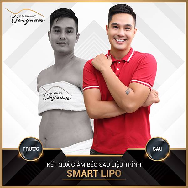 Hình ảnh trước và sau khi thực hiện liệu trình giảm béo bụng nam giới - Smart Lipo
