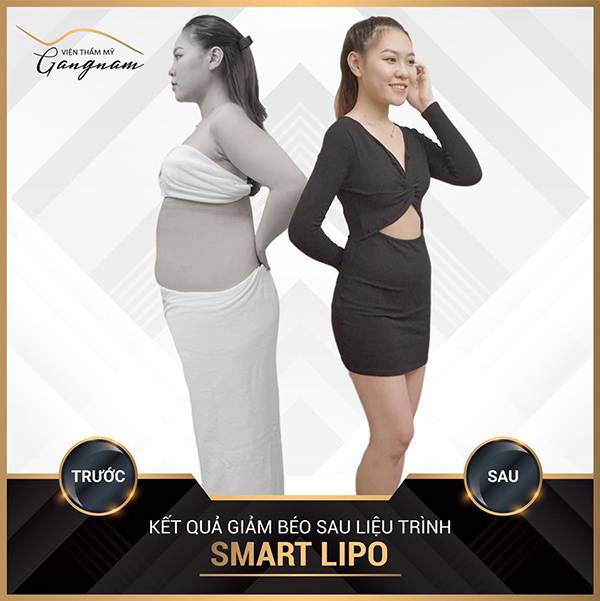 Cách giảm béo mặt và cằm bằng công nghệ Smart Lipo đã giúp chị Hương thay đổi hoàn toàn khuôn mặt, sau đó chị tiếp tục thực hiện giảm béo bụng và lấy lại vóc dáng thon gọn