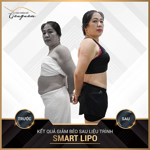 Cô khách đã đẩy lùi mỡ thừa sau liệu trình giảm mỡ toàn thân trong 1 tuần Smart Lipo