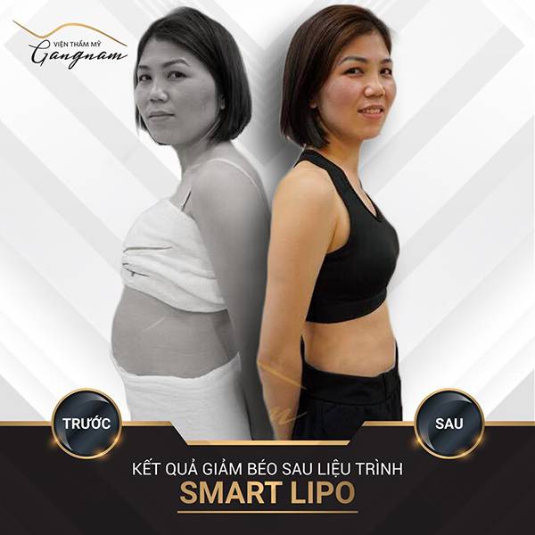 Chị Hoài khoe eo thon sau khi giảm 16 cm vòng bụng, Trước đó chị cũng đã thực hiện cách giảm béo mặt và cằm bằng Smart Lipo