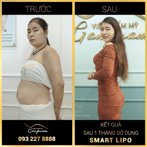 Chị Thu Thuỷ giảm 11kg sau 1 lần thực hiện giảm mỡ bụng và hông với Smart Lipo