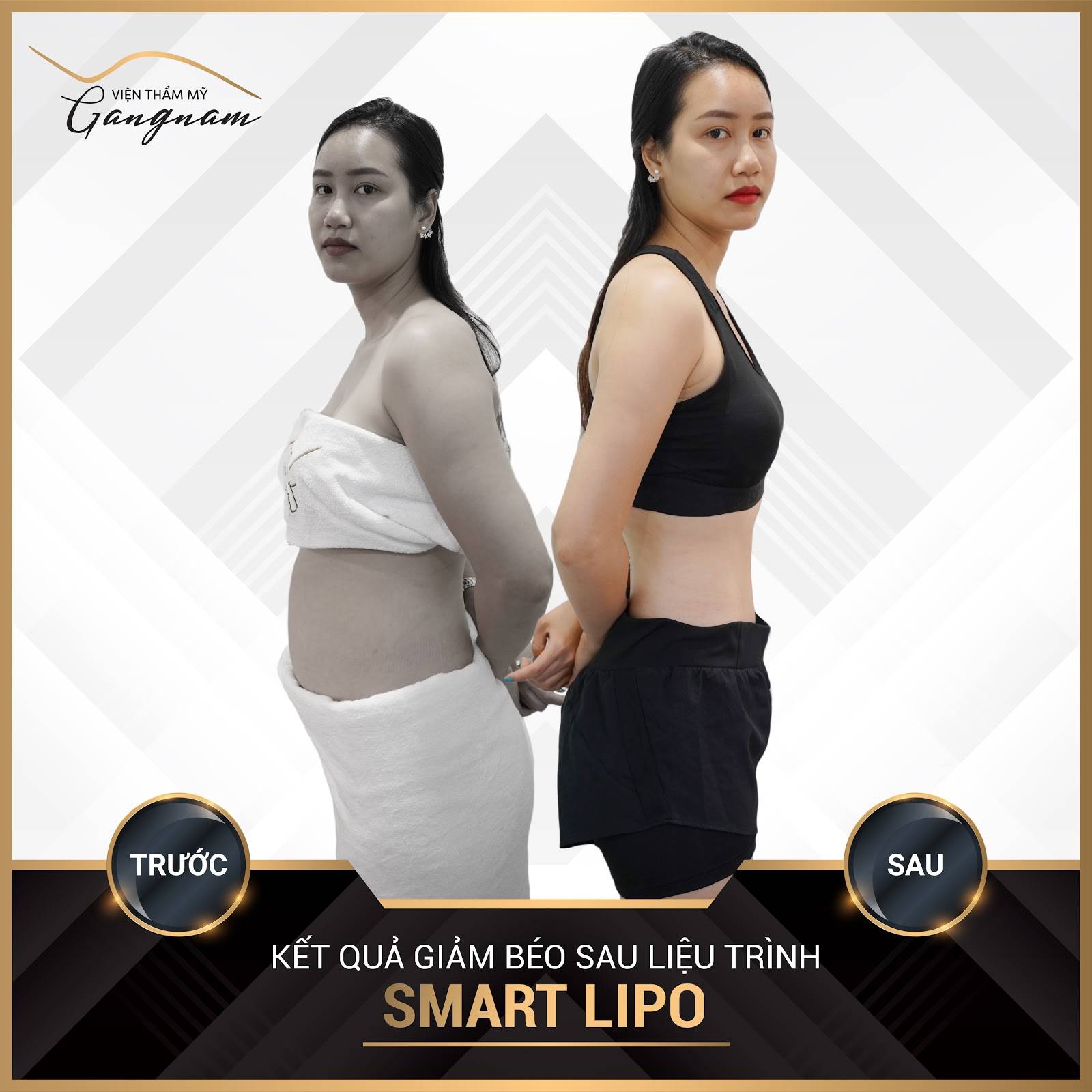 Chị Linh (29 tuổi) giảm mỡ phần bắp tay, bụng eo hiệu quả với Smart Lipo