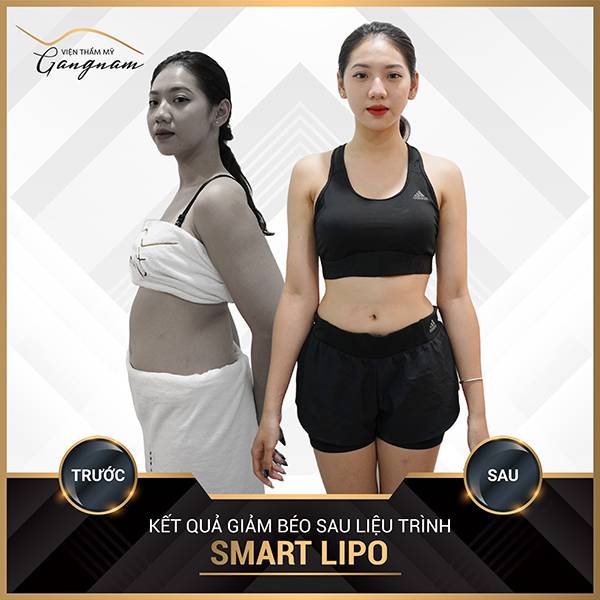 Chị Thanh Hà (35 tuổi) với đường cong mỹ miều sau khi thực hiện công nghệ Smart Lipo với kết quả mỹ mãn: giảm 3 kg cân nặng & 32 cm vùng bụng hông