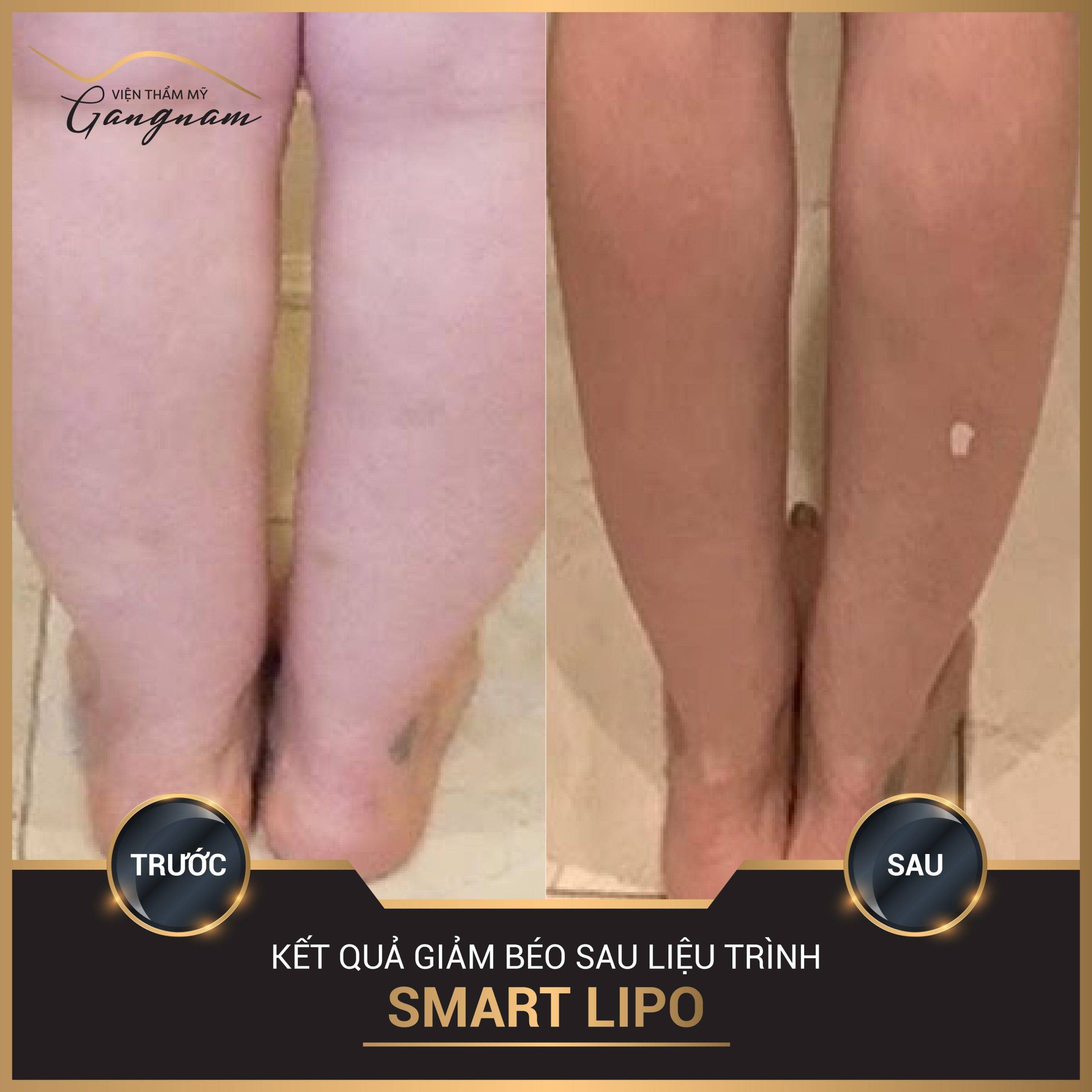 Hình ảnh kết quả sau 15 ngày giảm béo, giảm mỡ bắp chân với Smart Lipo