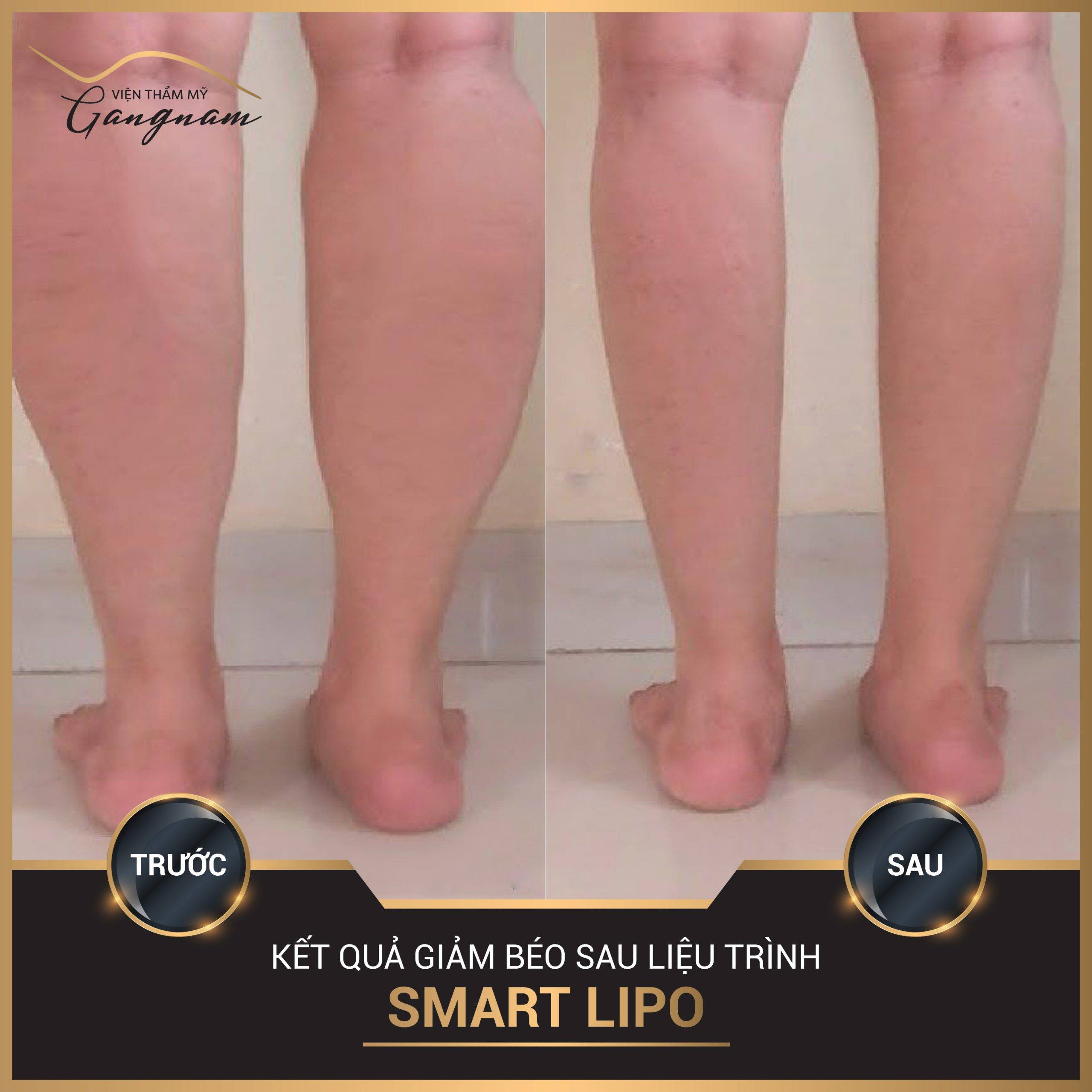 Hình ảnh khách hàng trước và sau giảm béo, giảm mỡ bắp chân với Smart Lipo