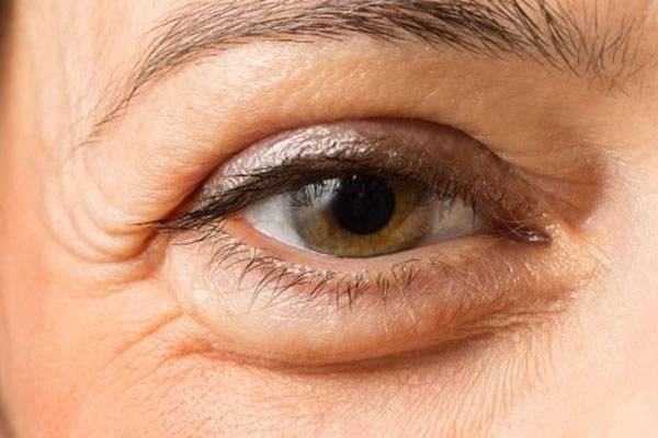 Bọng mắt là biểu hiện dấu hiệu lão hóa da rõ nét bạn có thể thấy được khi bước vào độ tuổi lão hóa.