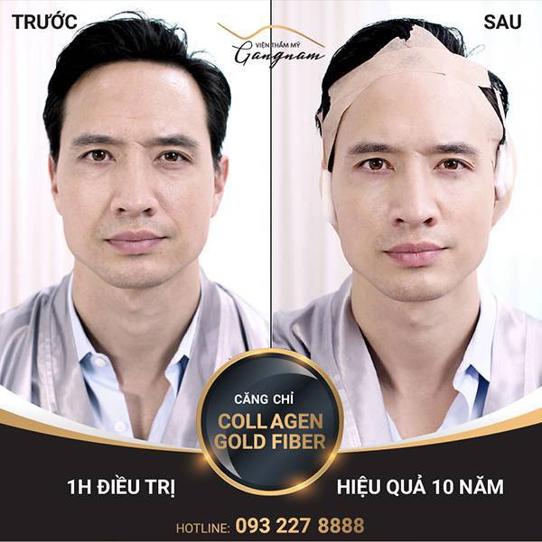 Diễn viên Kim Lý lựa chọn trẻ hóa da bằng chỉ Collagen Gold Fiber bởi độ hiệu quả và an toàn