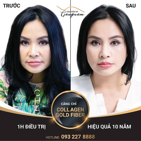 Diva Thanh Lam cũng lựa chọn chỉ collagen - vàng giải quyết tình trạng nếp nhăn