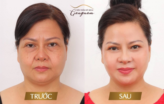 Khách hàng trước và sau khi căng chỉ Collagen Gold Fiber