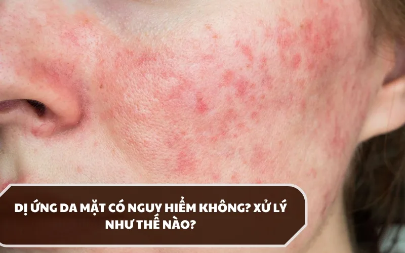 Các dấu hiệu nhận biết dị ứng da mặt, nguyên nhân và hướng xử lý