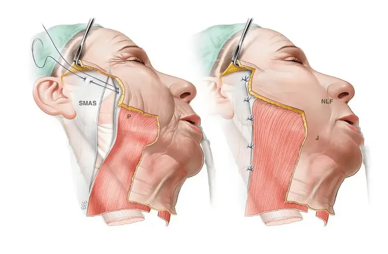 Phẫu thuật căng da mặt hiện nay đã tập trung vào xử lý cấu trúc bên dưới da để cơ mặt được trẻ hóa tự nhiên