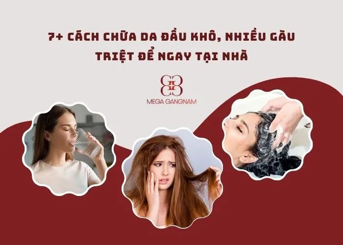 7+ cách chữa da đầu khô, nhiều gàu triệt để ngay tại nhà