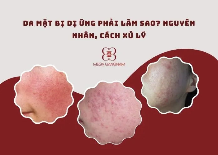 Da mặt bị dị ứng phải làm sao? Nguyên nhân, cách xử lý