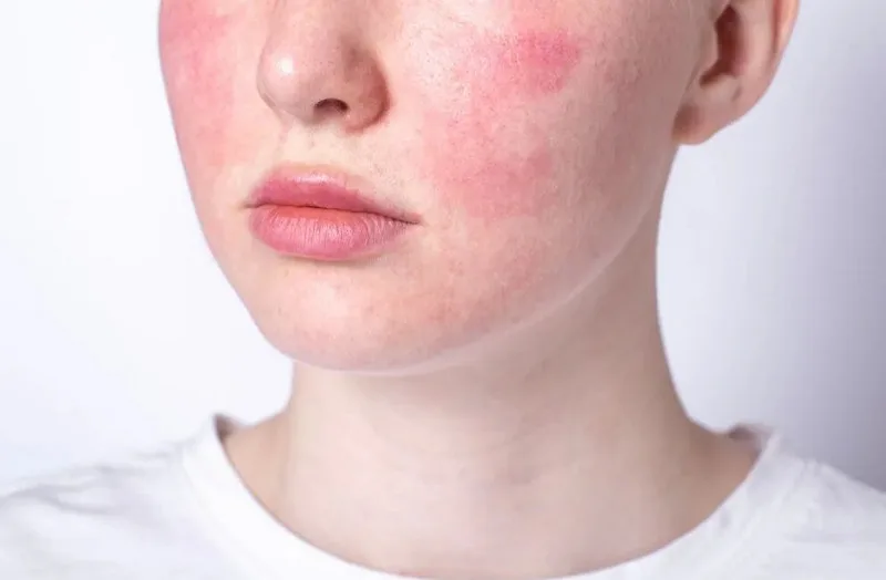 Hội chứng đỏ mặt rosacea có thể là một nguyên nhân khiến bạn bị đỏ da, nóng mặt. 