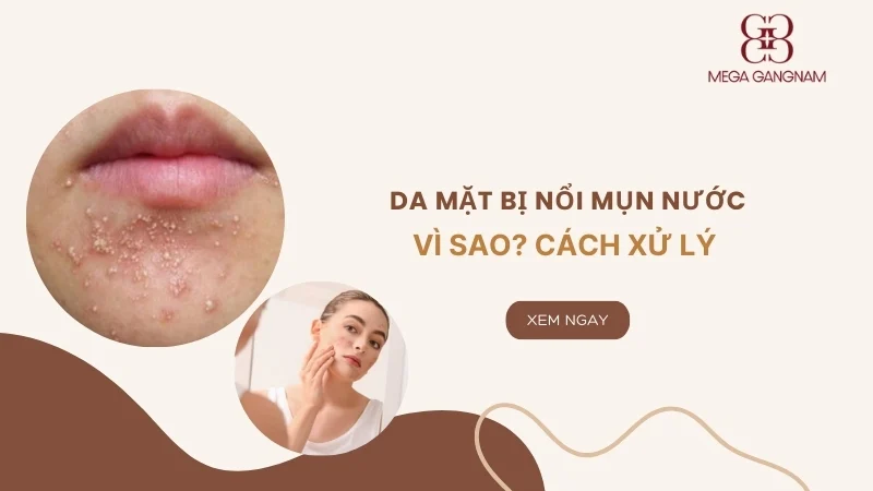 Da mặt bị nổi mụn nước vì sao? Cách xử lý