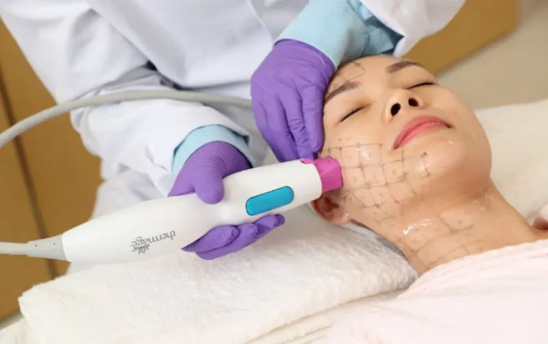 Thermage sử dụng sóng RF để tăng sinh collagen dưới da, làm căng phẳng nếp nhăn và tăng đàn hồi trên da 